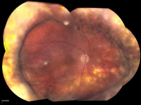 Retinal Detachment With Dislocated Iol Lens Retina Image Bank