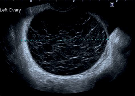 Chapter 8 Sonographic Assessment Of Ovarian Cysts And Masses Obgyn Key