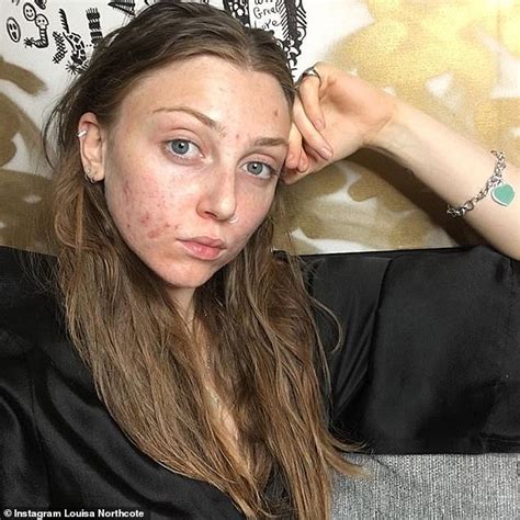 Former Britains Next Top Model Reveals How Miracle All Natural Vegan Cream Helped Cure Her