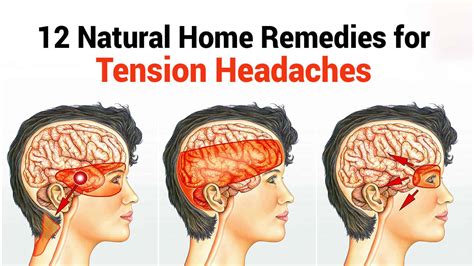 12 Natural Home Remedies For Tension Headaches 5 Minute Read