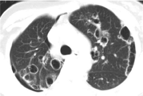 Hrct Shows Extensive Cystic Air Spaces Throughout Both Lungs With Right