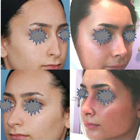 Check spelling or type a new query. Before And After Deviated Septum (1) » Rhinoplasty: Cost ...