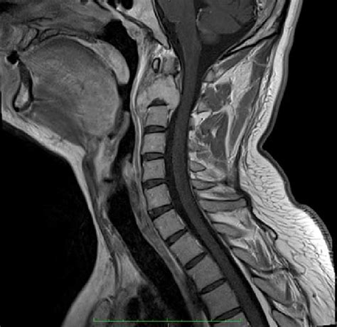 Sagittal T Weighted Mri Of The Cervical And Thoracic Spine A And My XXX Hot Girl