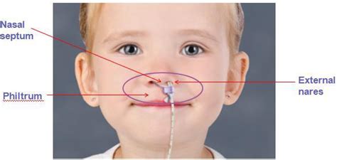 Nasal Bridle Tube Retaining System