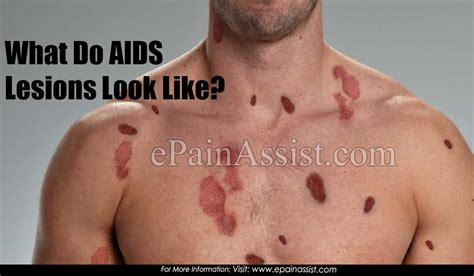 What Do Aids Lesions Look Like