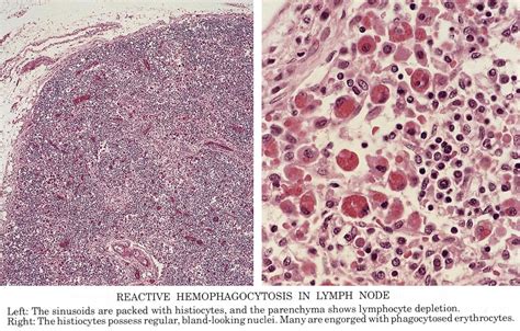 Pathology Outlines Hemophagocytic Lymphohistiocytosis