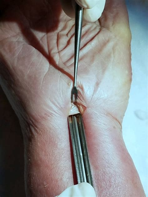 Disposable Seg Way Endoscopic Carpal Tunnel Release Ectr Pacific