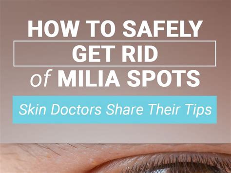 How To Remove Milia Spots Howotremvo