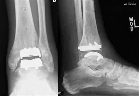 Ankle Replacement Or Ankle Fusion Which Surgery Is Best For Ankle