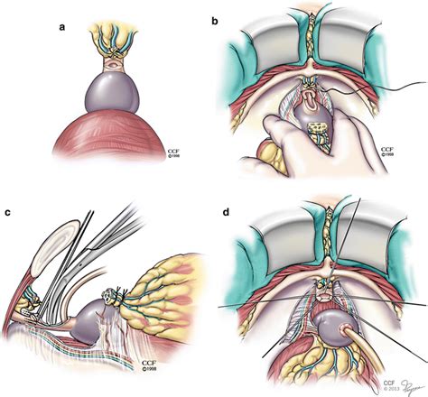 Open Radical Retropubic Prostatectomy And Pelvic Lymph Node Dissection SpringerLink