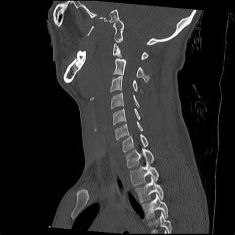 Atlanto Occipital Dissociation Traynelis Type 1 C2 Teardrop Fracture