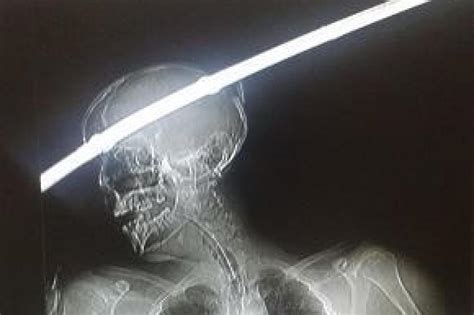 Man Impaled With Iron Rod Through His Skull In Car Crash Survives The Scottish Sun