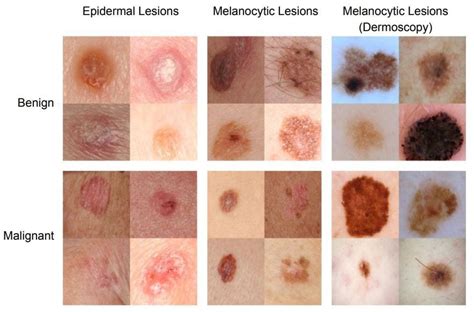 Stage 4 Early Stage Melanoma Skin Cancer CancerWalls