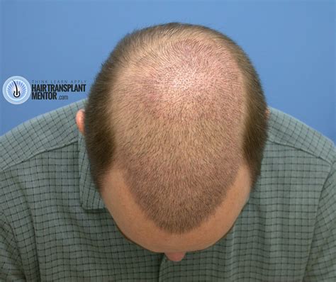 Hair Transplant Surgery Before And After