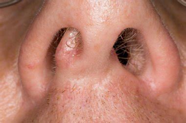 Nasal Polyps Facts You Should Know Perfect Therapy