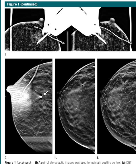 Digital Breast Tomosynthesis Guided Vacuum Assisted Breast Biopsy