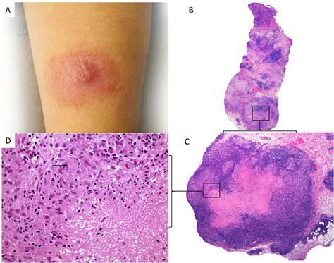Cutaneous Leishmaniasis Presenting As An Erythematous Nodule A With Download Scientific