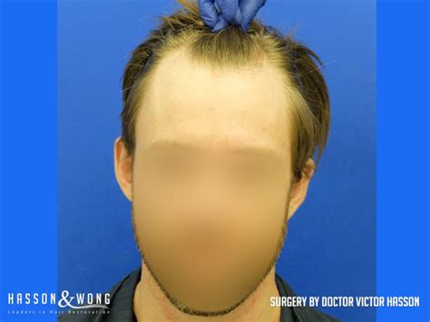 Hair Transplant Photos Hair Transplant Before And After