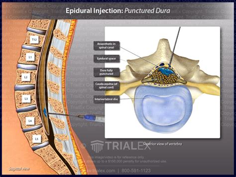 Epidural Injection Punctured Dura Trialexhibits Inc