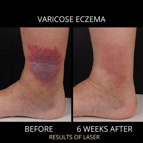 Is Varicose Eczema Curable The Veincare Centre