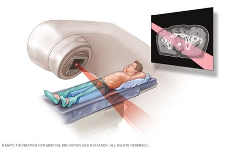 Radioterapia De Haz Externo Para El C Ncer De Pr Stata Mayo Clinic