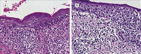 Lymphomatoid Keratosis Dermatology Jama Dermatology The Jama Network