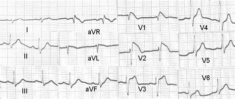 Brugada Syndrome All About Cardiovascular System And Disorders