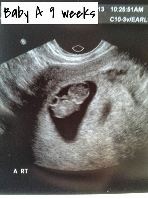 This ultrasound will probably be performed transvaginally, and you'll be able to confirm that you're carrying a uterine pregnancy — as opposed to an ectopic pregnancy. A baby for you: 9 Weeks
