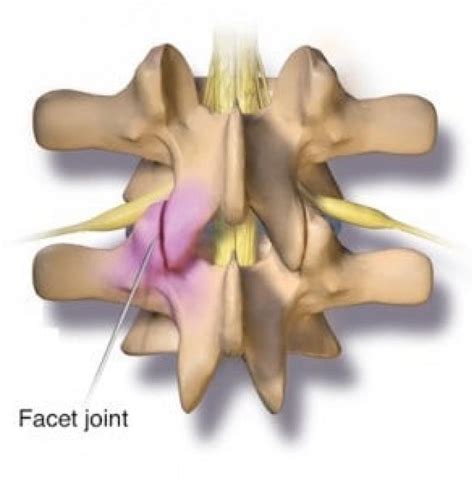 Synovial Cyst Diagnosis And Treatment Nyc Columbia Neurosurgery In