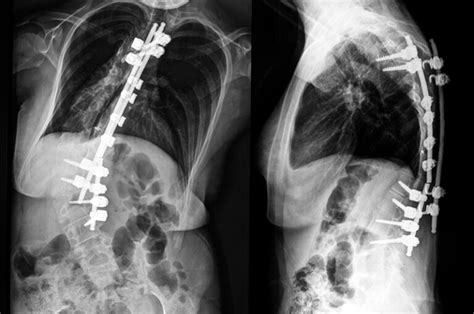 Scoliosis Surgery Scoliosis Solutions