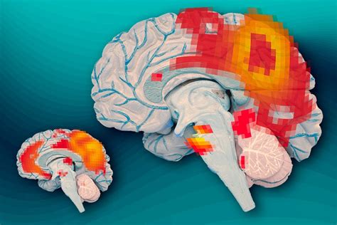 Inside The Adult Adhd Brain Mit News Massachusetts Institute Of