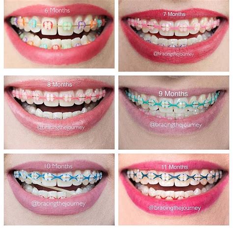 All Braces Band Colors Warehouse Of Ideas
