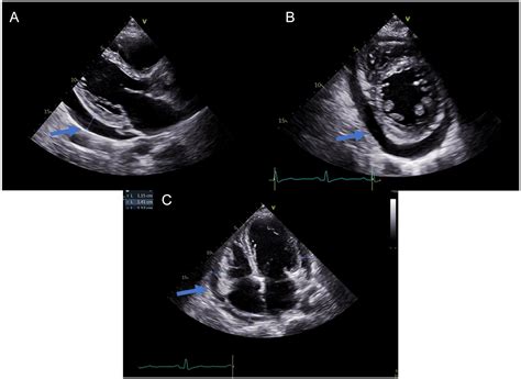 Right Heart Failure With Recurrent Pericardial Effusion Mimicking Effusive Constrictive