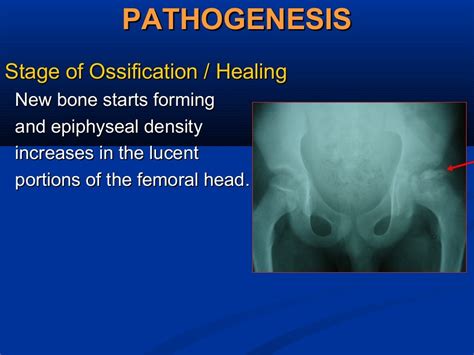 Perthes Disease