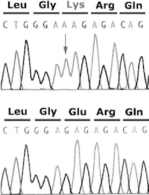Figure 1 From A Novel Mutation Of Androgen Receptor Gene In Complete Androgen Insensitivity