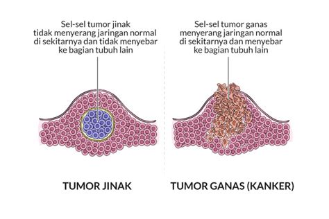 Tumor Gejala Penyebab Dan Mengobati Alodokter