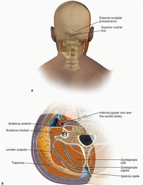 Minimally Invasive Posterior Cervical Laminoforaminotomy