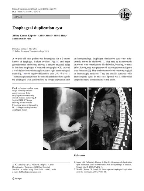 Pdf Esophageal Duplication Cyst