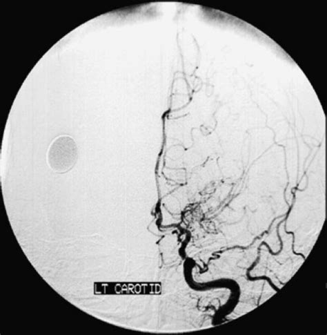 Angiogram Showing Occluded Middle Cerebral Artery With Markedly Dilated Download Scientific