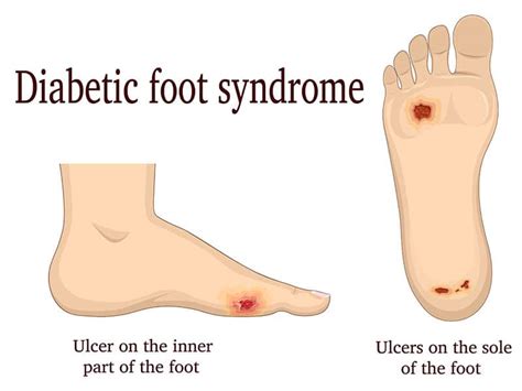 5 Tips For The Diabetic Foot Walkrite Foot Clinic