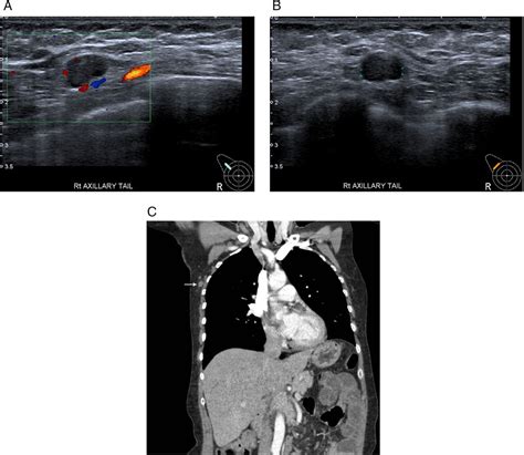 Radioactive Seed Localisation To Guide Removal Of Impalpable Lymph