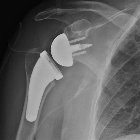 Reverse Total Shoulder Replacement Dr Sunil Reddy
