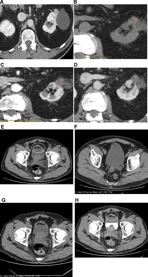 A Axial View Of A Contrast Enhanced Abdominal And Pelvic Ct Scan