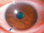 角膜傷後糜爛 雷射可改善 | 眼部 | 健康百科 | 元氣網