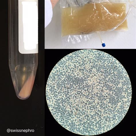 Urine Sediment Of The Month Beyond The Urizon Renal Fellow Network