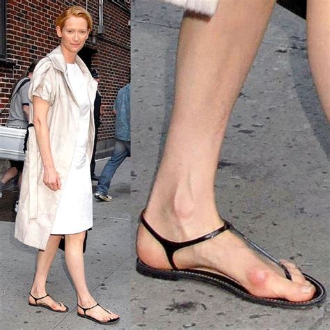 Celebrity Bunions How To Prevent And Treat Foot Deformities