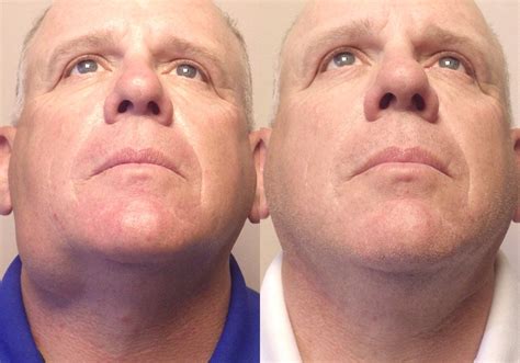 Facial Cyst Removal Patient Guyette Facial Oral Surgery Center