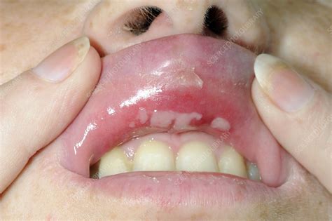 Aphthous Ulcers Inside Upper Lip Stock Image C0106680 Science Photo Library