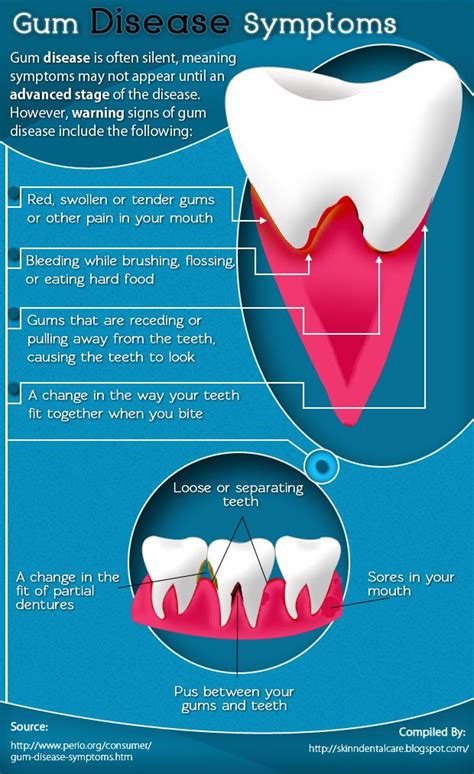 Symptoms Of Gum Diseases Infographic Visual Ly Gum Disease