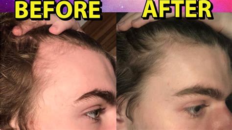 Hyper Responder To Minoxidil Reverses Hair Loss In 3 Months And Obtains